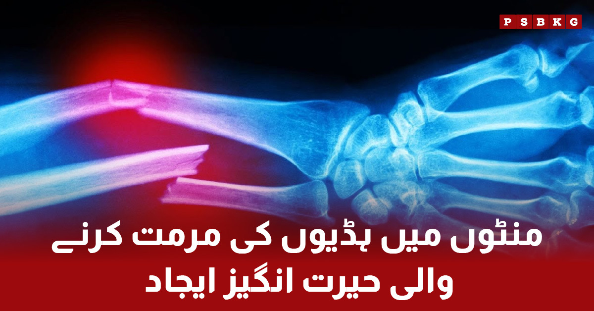 Chinese scientists invention Bone-02 bone glue