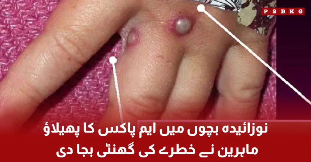 Doctors warning about mpox cases in newborn babies in Pakistan