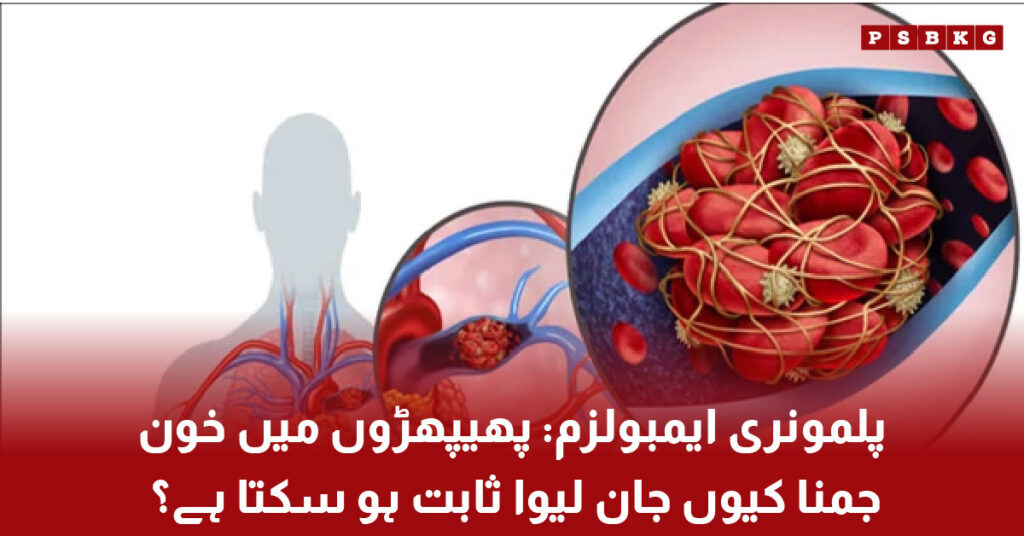 Human lungs showing blood clot causing pulmonary embolism and breathing difficulty medical condition illustration