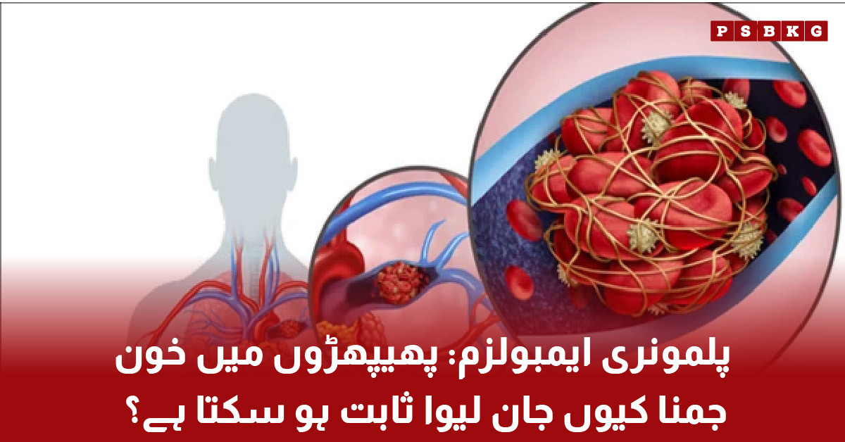 Human lungs showing blood clot causing pulmonary embolism and breathing difficulty medical condition illustration